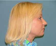 Liposuction After Photo by Arturo Guiloff, MD; Palm Beach Gardens, FL - Case 31171