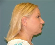 Liposuction Before Photo by Arturo Guiloff, MD; Palm Beach Gardens, FL - Case 31171
