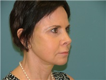 Skin rejuvenation and resurfacing After Photo by Arturo Guiloff, MD; Palm Beach Gardens, FL - Case 31183