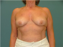 Breast Reconstruction Before Photo by Arturo Guiloff, MD; Palm Beach Gardens, FL - Case 31350