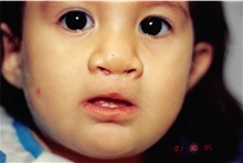 Cleft Lip and Palate Repair After Photo by Arturo Guiloff, MD; Palm Beach Gardens, FL - Case 31682