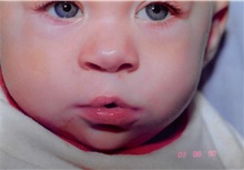 Cleft Lip and Palate Repair After Photo by Arturo Guiloff, MD; Palm Beach Gardens, FL - Case 31683
