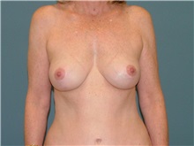 Breast Lift After Photo by Arturo Guiloff, MD; Palm Beach Gardens, FL - Case 31685