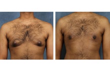 Male Breast Reduction After Photo by James Boynton, MD, FACS; Houston, TX - Case 24098