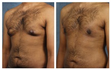 Male Breast Reduction Before Photo by James Boynton, MD, FACS; Houston, TX - Case 24098