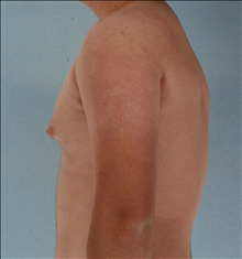 Male Breast Reduction Before Photo by James Boynton, MD, FACS; Houston, TX - Case 24098