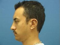 Rhinoplasty After Photo by William Starr, MD; Camarillo, CA - Case 7354