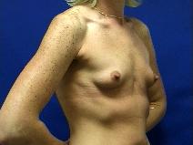 Breast Augmentation Before Photo by William Starr, MD; Camarillo, CA - Case 7356