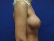Breast Augmentation After Photo by William Starr, MD; Camarillo, CA - Case 7356