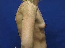 Breast Augmentation Before Photo by William Starr, MD; Camarillo, CA - Case 7356