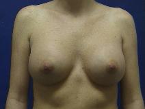 Breast Augmentation After Photo by William Starr, MD; Camarillo, CA - Case 7474