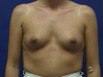 Breast Augmentation Before Photo by William Starr, MD; Camarillo, CA - Case 7474