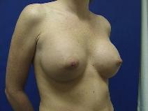 Breast Augmentation After Photo by William Starr, MD; Camarillo, CA - Case 7474