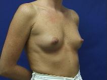 Breast Augmentation Before Photo by William Starr, MD; Camarillo, CA - Case 7474