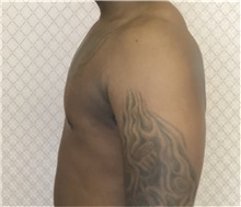 Male Breast Reduction After Photo by David Azouz, MD; Dallas, TX - Case 34285
