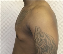 Male Breast Reduction Before Photo by David Azouz, MD; Dallas, TX - Case 34285