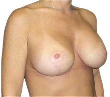 Breast Lift After Photo by David Azouz, MD; Dallas, TX - Case 34286