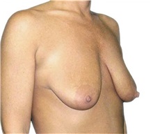 Breast Lift Before Photo by David Azouz, MD; Dallas, TX - Case 34286