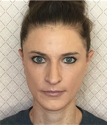 Chemical Peels, IPL, Fractional CO2 Laser Treatments After Photo by David Azouz, MD; Dallas, TX - Case 34293