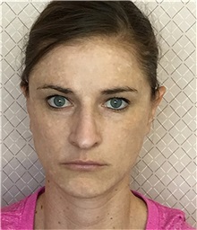Chemical Peels, IPL, Fractional CO2 Laser Treatments Before Photo by David Azouz, MD; Dallas, TX - Case 34293