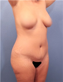 Liposuction Before Photo by Marvin Shienbaum, MD; Brandon, FL - Case 30062