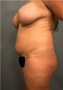 Liposuction Before Photo by Marvin Shienbaum, MD; Brandon, FL - Case 30063