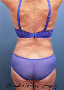 Liposuction After Photo by Marvin Shienbaum, MD; Brandon, FL - Case 30066