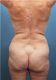 Liposuction Before Photo by Marvin Shienbaum, MD; Brandon, FL - Case 30066