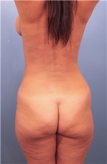 Liposuction Before Photo by Marvin Shienbaum, MD; Brandon, FL - Case 30068