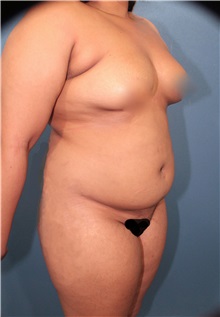 Liposuction Before Photo by Marvin Shienbaum, MD; Brandon, FL - Case 30069