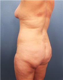 Liposuction Before Photo by Marvin Shienbaum, MD; Brandon, FL - Case 30070