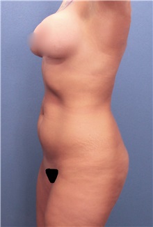 Liposuction Before Photo by Marvin Shienbaum, MD; Brandon, FL - Case 30073