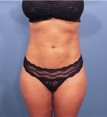 Liposuction After Photo by Marvin Shienbaum, MD; Brandon, FL - Case 30074