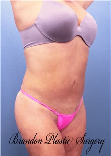 Liposuction After Photo by Marvin Shienbaum, MD; Brandon, FL - Case 30075