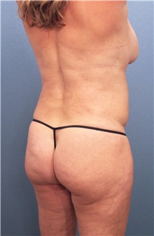 Liposuction Before Photo by Marvin Shienbaum, MD; Brandon, FL - Case 30075