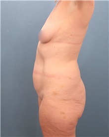 Liposuction Before Photo by Marvin Shienbaum, MD; Brandon, FL - Case 30076