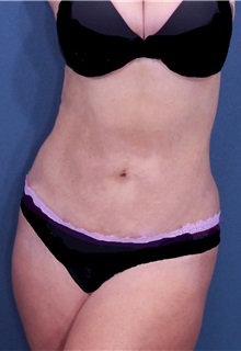 Liposuction After Photo by Marvin Shienbaum, MD; Brandon, FL - Case 30077