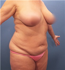 Liposuction Before Photo by Marvin Shienbaum, MD; Brandon, FL - Case 30078