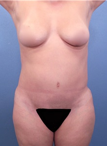 Liposuction Before Photo by Marvin Shienbaum, MD; Brandon, FL - Case 30084