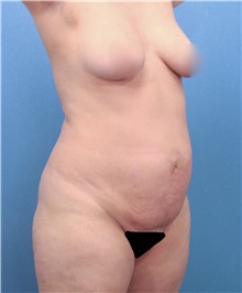 Liposuction Before Photo by Marvin Shienbaum, MD; Brandon, FL - Case 30084