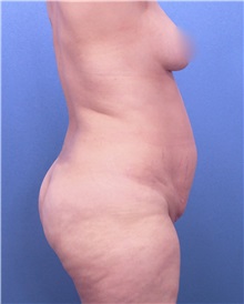 Liposuction Before Photo by Marvin Shienbaum, MD; Brandon, FL - Case 30084