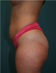 Liposuction Before Photo by Marvin Shienbaum, MD; Brandon, FL - Case 30316