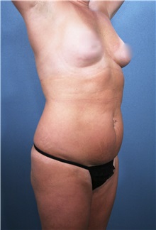 Liposuction Before Photo by Marvin Shienbaum, MD; Brandon, FL - Case 30318