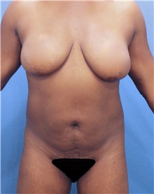 Liposuction Before Photo by Marvin Shienbaum, MD; Brandon, FL - Case 30319