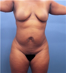 Liposuction Before Photo by Marvin Shienbaum, MD; Brandon, FL - Case 30320