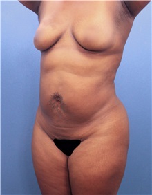 Liposuction Before Photo by Marvin Shienbaum, MD; Brandon, FL - Case 30320