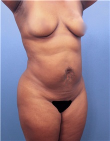 Liposuction Before Photo by Marvin Shienbaum, MD; Brandon, FL - Case 30320