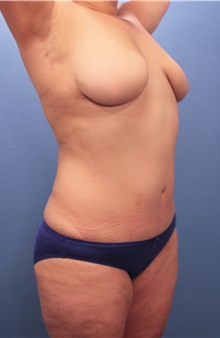Liposuction After Photo by Marvin Shienbaum, MD; Brandon, FL - Case 30321