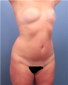 Liposuction Before Photo by Marvin Shienbaum, MD; Brandon, FL - Case 30322