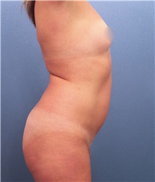 Liposuction Before Photo by Marvin Shienbaum, MD; Brandon, FL - Case 30322